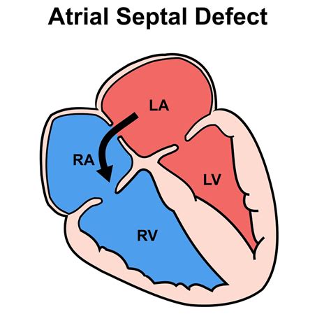 Atrial Septal Defect - Causes, Symptoms, Types, Diagnosis, Treatment