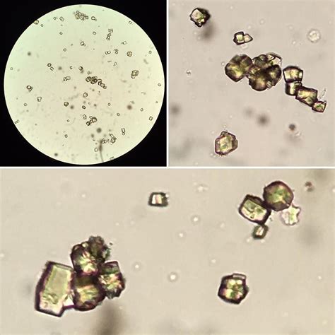 Uric Acid Crystals in Urine - MaryjaneqoEnglish