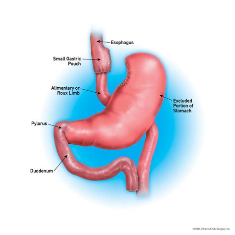 What Is Gastric Bypass Surgery? - Weight Loss Surgery