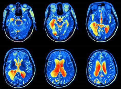 Toxic encephalopathy definition, causes, symptoms, diagnosis, treatment ...