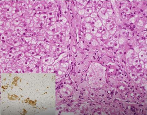 Metabolic liver disease in childhood - Diagnostic Histopathology