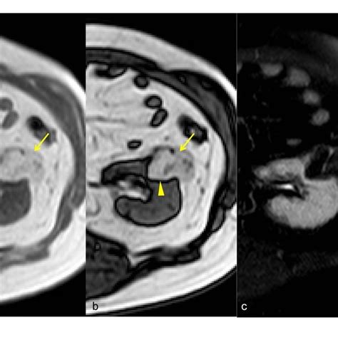 Giant Angiomyolipoma. MRI: Coronal T2-weighted (a) and STIR sequence ...