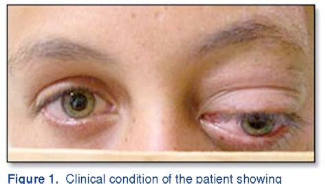 Retrobulbar hemorrhage: a case report. - Semantic Scholar