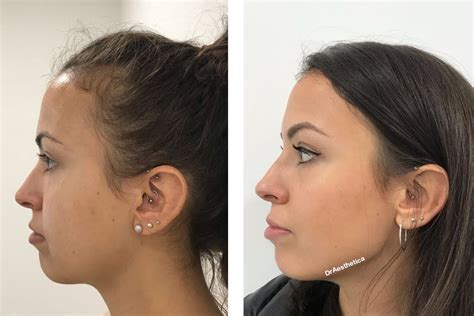 Botox for Jowls: Non Surgical Jowl Lift - Dr Aesthetica