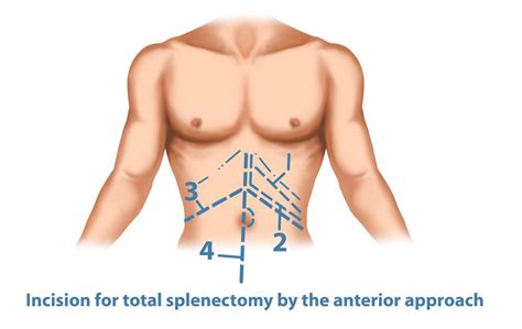 Splenectomy Perth | Surgical Removal of The Spleen | Spleen Removal