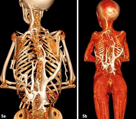 The stone man disease: fibrodysplasia ossificans progressiva: imaging revisited -- Verma et al ...