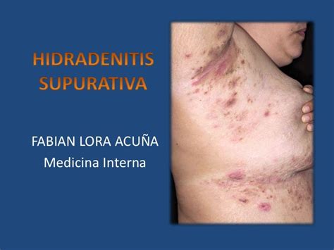 Hidradenitis supurativa