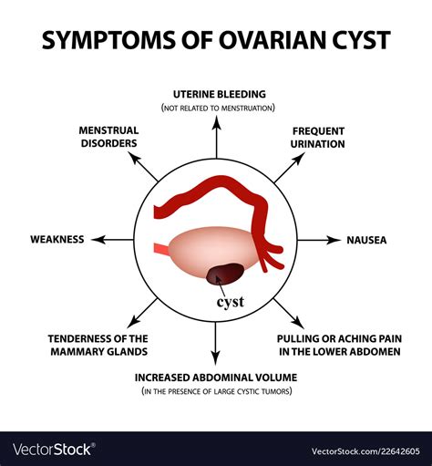 Ovarian Cyst Symptoms