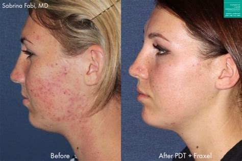 Blue Light Laser Acne Treatment | San Diego, CA | CLDerm