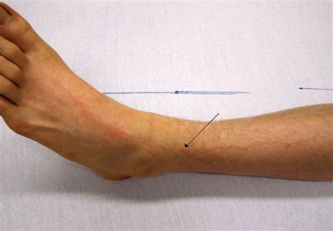 Lichtenberg figures are seen in? - Forensic MCQ « PG Blazer