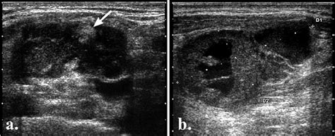 Intranodal necrosis: a) coagulation necrosis (arrow); b) liquefaction... | Download Scientific ...