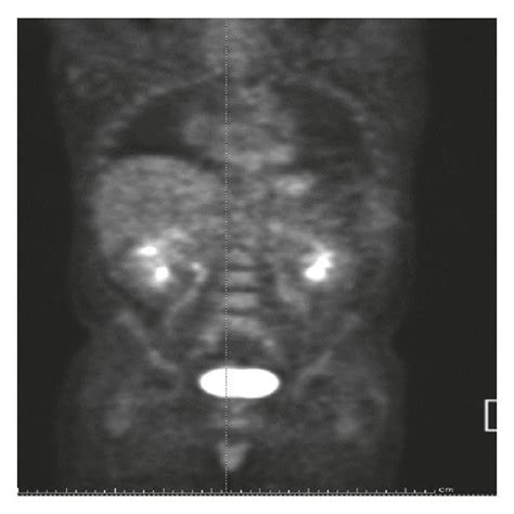 PET scan showing varying degrees of negligible, low-grade, and ...