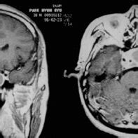 -Pituitary apoplexy – MRI images | Download Scientific Diagram