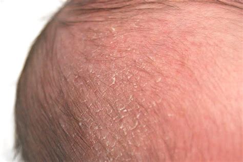 Cradle Cap - Causes, Symptoms And Other Related Information