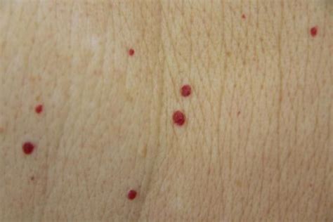 Do You Have These Red Spots On Your Body? Should You Worry? Read What Should You! | Body, Health ...