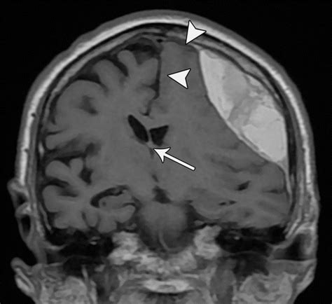 Subfalcine Herniation