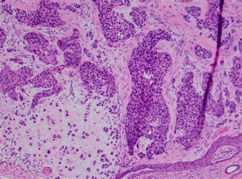 Syringoma Histology