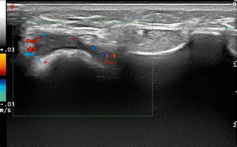 US of the wrist: synovial hypertrophy with poorly enhanced synovial ...