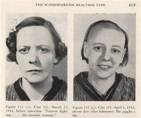 Before And After Lobotomy Procedure