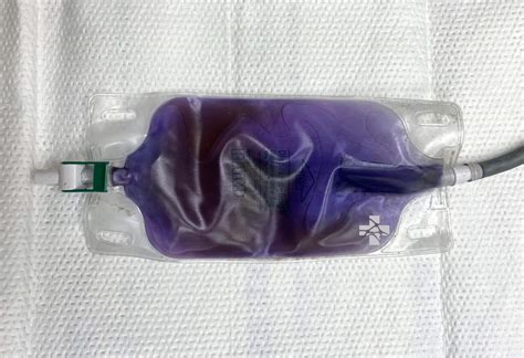 Purple Urine Bag Syndrome: A visual diagnosis and what it means for your patient