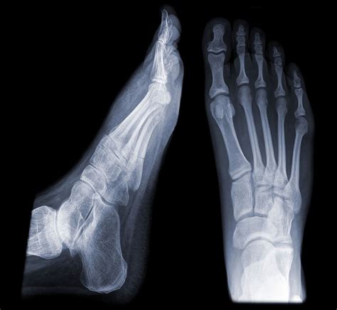 Metatarsal stress fracture: Mechanism of injury, signs, and treatment ...