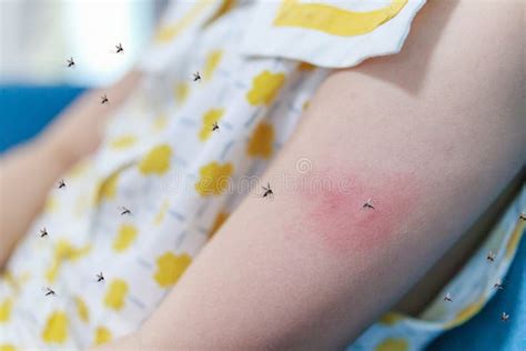 Little Girl Has Skin Rash Allergy and Itchy on Her Arm from Mosquito ...