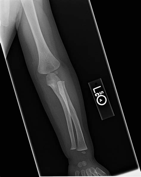 Nursemaid's Elbow - Pediatrics - Orthobullets