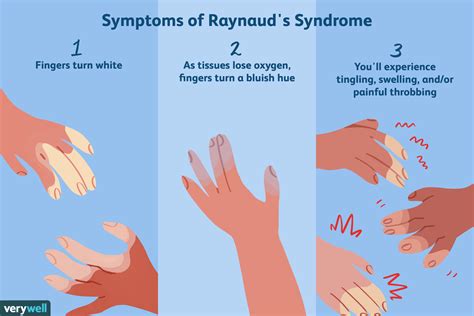 Raynaud's Syndrome: Symptoms, Diagnosis, and Treatment