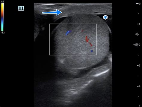 Fig 2 - Epididymo-orchitis | ALiEM