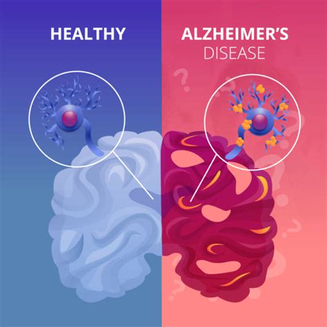 Alzheimer's Disease: The Basics - Alzheimer's Los Angeles