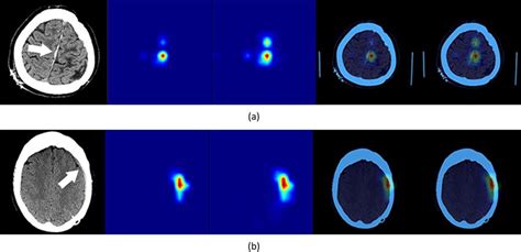 (a,b) Two examples of SDH that were missed by a radiologist but ...