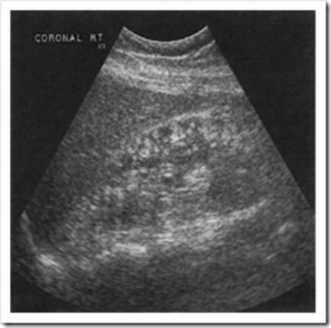 Ultrasound images of Angiomyolipoma - Radiology Imaging