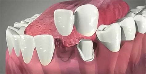 Dental Bridge - Procedure, Dental Bridge Vs Dental Implant