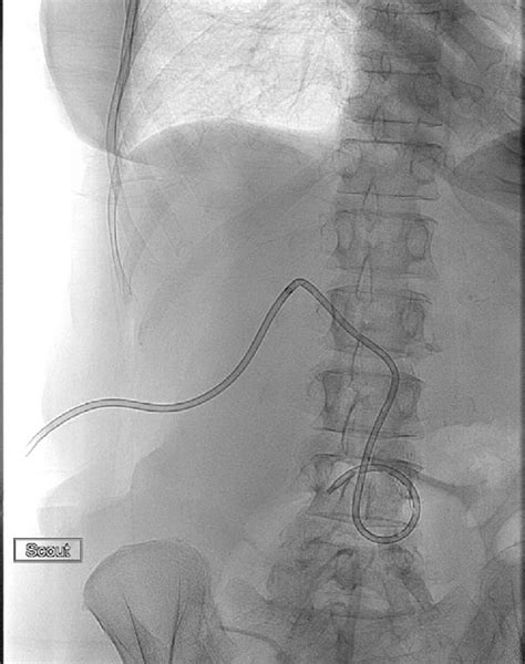 e Placement of an internal-external biliary drain. | Download ...