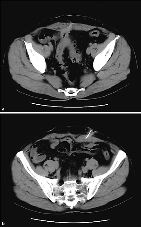 colocutaneous fistula | Semantic Scholar