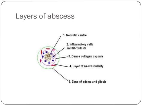 Brain abscess