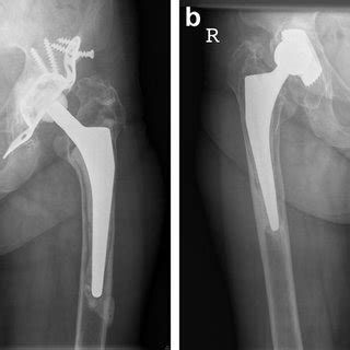 Revision of the left total hip arthroplasty using a transfemoral ...