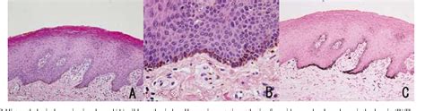 Figure 2 from Labial melanotic macule diagnosed by dermoscopy. | Semantic Scholar