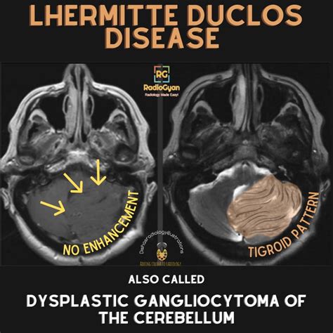 Lhermitte Duclos Disease | Radiology Case | - RadioGyan