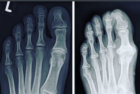 Hallux Rigidus Surgery Germany - Dusseldorf | Adem Erdogan