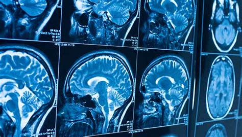 Brain Tumor Types | Johns Hopkins Medicine