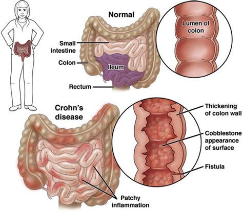 Crohn's Disease - GENEGUT