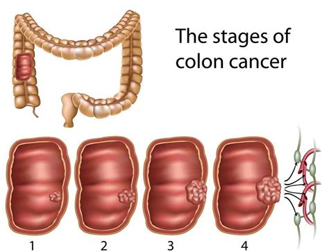 Here Is How This 70-Year-Old Man Naturally Cured His Late Stage Colon Cancer