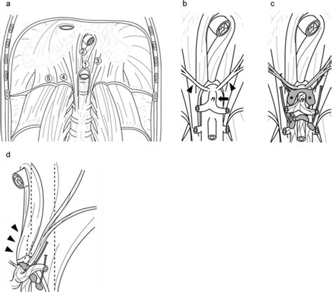 The anatomy around the median arcuate ligament. a The anatomy of the ...