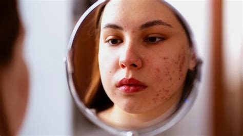 Skin Diseases Prevention and Early Detection - Buzztify