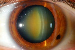 Cataract Surgery – West Coast Cornea