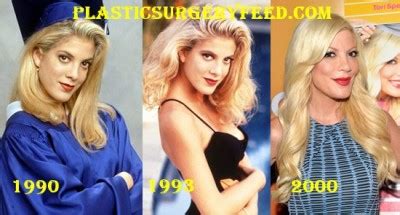 Tori Spelling Before and After Plastic Surgery - Plastic Surgery Feed