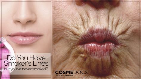 Smoking Effects On Lips