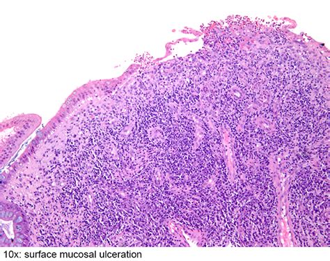 Pathology Outlines - Inflammatory polyp