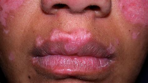 Discoid Lupus Erythematosus Oral Lesions